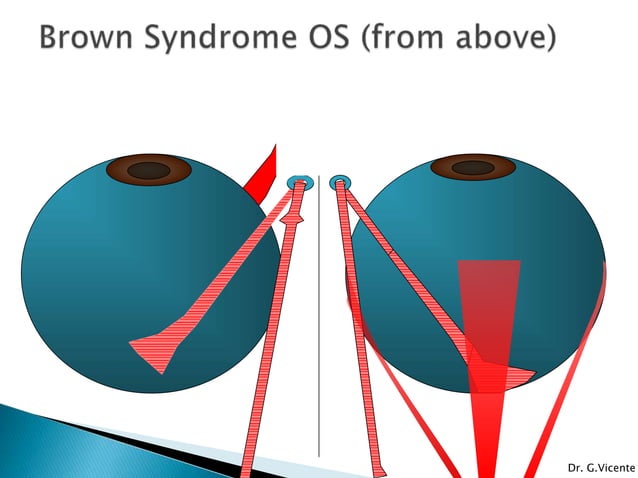brown-s-syndrome-pptx-eye-and-vision-conditions-diseases-and