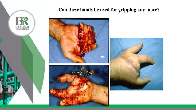 Hand Work Injuries Campaign hand and finger injury safety.pptx