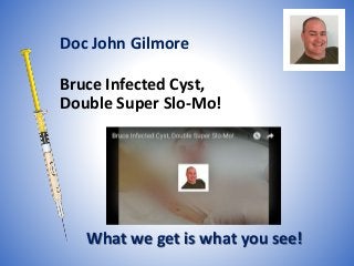 Bruce Infected Cyst,
Double Super Slo-Mo!
What we get is what you see!
Doc John Gilmore
 