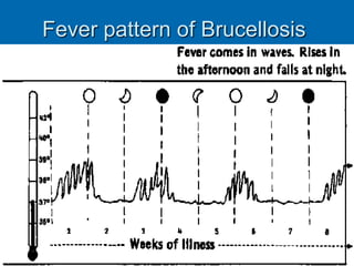 Fever pattern of Brucellosis
 