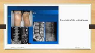 24-09-2020ABHIJITH SP CVAS POOKODE 13
Degeneration of inter-vertebral spaces
 