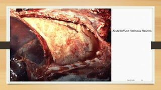 Acute Diffuse Fibrinous Pleuritis
24-09-2020ABHIJITH SP CVAS POOKODE 18
 
