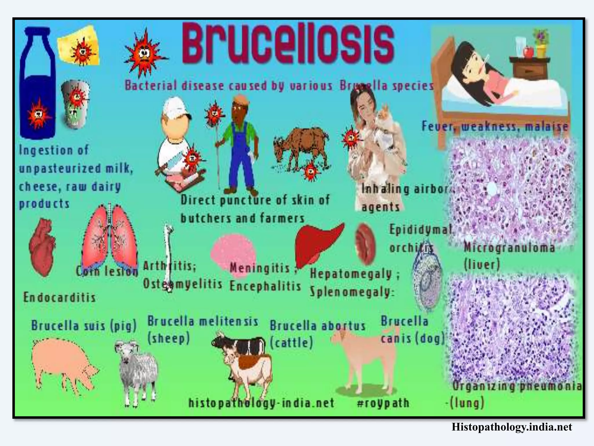 Brucellosis ppt | PPT