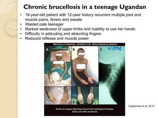 Brucellosis in humans and livestock in Uganda: Challenges and opportunities