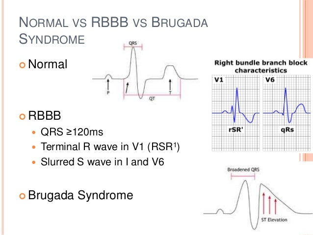 Dr. Smith's ECG Blog Chest Pain and Right Bundle Branch Block