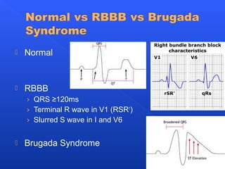  Normal
 RBBB
› QRS ≥120ms
› Terminal R wave in V1 (RSR1
)
› Slurred S wave in I and V6
 Brugada Syndrome
 