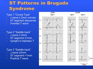 Type 1 “Coved Type”
 J wave ≥ 2mm convex
 ST segment descends
 Inverted T wave
Type 2 “Saddle back”
 J wave ≥ 2mm
 ST segment ≥1mm
 Upright or biphasic T
Type 3 “Saddle back”
 J wave ≥2mm
 ST segment <1mm
 Positive T wave
 