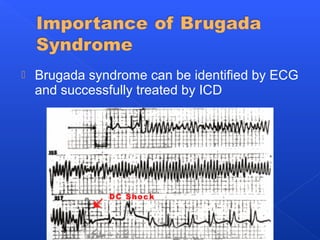  Brugada syndrome can be identified by ECG
and successfully treated by ICD
 
