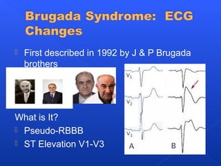  First described in 1992 by J & P Brugada
brothers
What is It?
 Pseudo-RBBB
 ST Elevation V1-V3
 