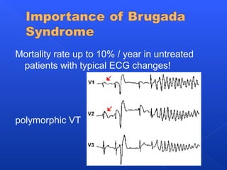 Mortality rate up to 10% / year in untreated
patients with typical ECG changes!
polymorphic VT
 
