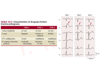 Brugada syndrome | PPTX