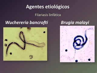 Agentes etiológicos
Filariasis linfática

Wuchereria bancrofti

Brugia malayi

 