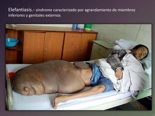 Elefantiasis.- síndrome caracterizado por agrandamiento de miembros
inferiores y genitales externos

 