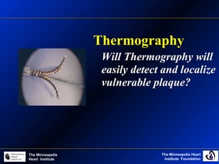The Minneapolis Heart
Institute Foundation
The Minneapolis
Heart Institute
Thermography
Will Thermography will
easily detect and localize
vulnerable plaque?
 