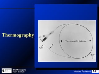 The Minneapolis Heart
Institute Foundation
The Minneapolis
Heart Institute
Thermography
 