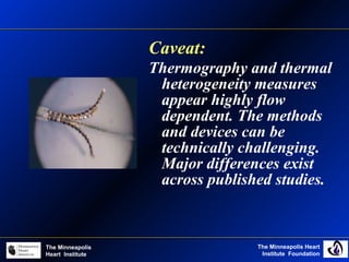 The Minneapolis Heart
Institute Foundation
The Minneapolis
Heart Institute
Caveat:
Thermography and thermal
heterogeneity measures
appear highly flow
dependent. The methods
and devices can be
technically challenging.
Major differences exist
across published studies.
 