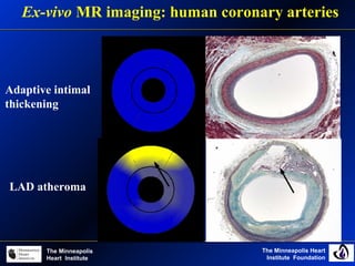 The Minneapolis Heart
Institute Foundation
The Minneapolis
Heart Institute
Ex-vivo MR imaging: human coronary arteries
Adaptive intimal
thickening
LAD atheroma
 
