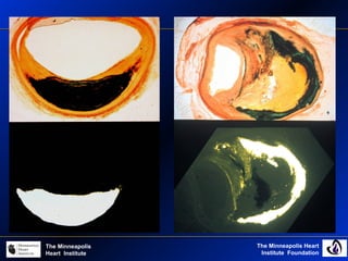 The Minneapolis Heart
Institute Foundation
The Minneapolis
Heart Institute
 
