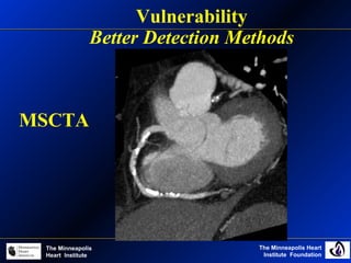 The Minneapolis Heart
Institute Foundation
The Minneapolis
Heart Institute
Vulnerability
Better Detection Methods
MSCTA
 