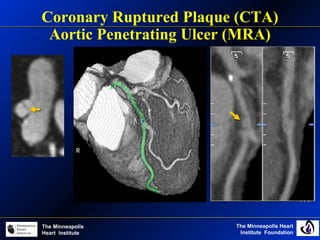 The Minneapolis Heart
Institute Foundation
The Minneapolis
Heart Institute
Coronary Ruptured Plaque (CTA)
Aortic Penetrating Ulcer (MRA)
 