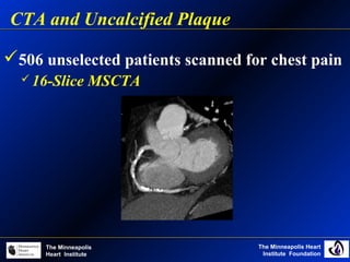 The Minneapolis Heart
Institute Foundation
The Minneapolis
Heart Institute
506 unselected patients scanned for chest pain
 16-Slice MSCTA
CTA and Uncalcified Plaque
 