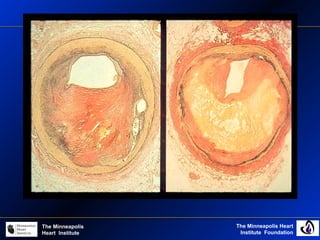 The Minneapolis Heart
Institute Foundation
The Minneapolis
Heart Institute
 