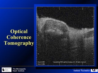 The Minneapolis Heart
Institute Foundation
The Minneapolis
Heart Institute
Optical
Coherence
Tomography
 