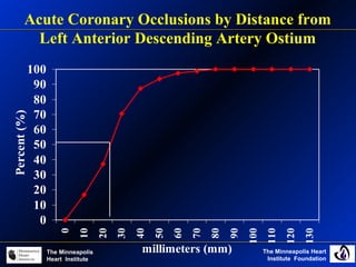 The Minneapolis Heart
Institute Foundation
The Minneapolis
Heart Institute
0
10
20
30
40
50
60
70
80
90
100 0
10
20
30
40
50
60
70
80
90
100
110
120
130
millimeters (mm)
Percent(%)Acute Coronary Occlusions by Distance from
Left Anterior Descending Artery Ostium
 