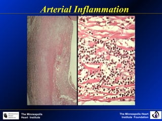 The Minneapolis Heart
Institute Foundation
The Minneapolis
Heart Institute
Arterial Inflammation
 