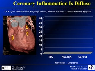 The Minneapolis Heart
Institute Foundation
The Minneapolis
Heart Institute
Coronary Inflammation Is Diffuse
0
5
10
15
20
25
30
35
40
IRA Non-IRA Control
Macrophages Lymphocytes
JACC April 2005 Mauriello, Sangiorgi, Fratoni, Palmieri, Bonanno, Anemona Schwartz, Spagnoli
 