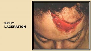 SPLIT
LACERATION
 