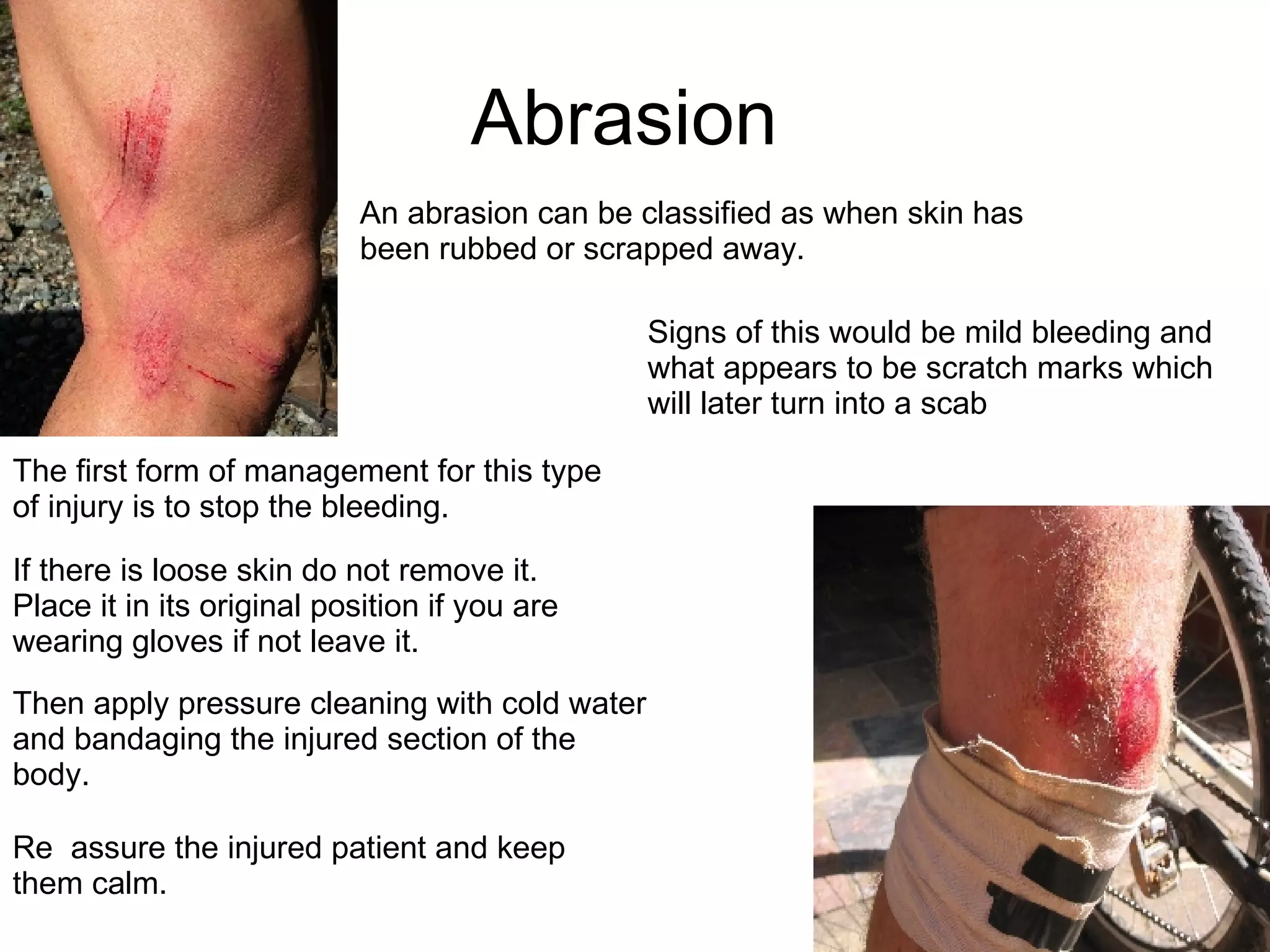 Abrasion  An abrasion can be classified as when skin has been rubbed or scrapped away. Signs of this would be mild bleeding and what appears to be scratch marks which will later turn into a scab The first form of management for this type of injury is to stop the bleeding. If there is loose skin do not remove it. Place it in its original position if you are wearing gloves if not leave it.  Then apply pressure cleaning with cold water and bandaging the injured section of the body.  Re  assure the injured patient and keep them calm.  