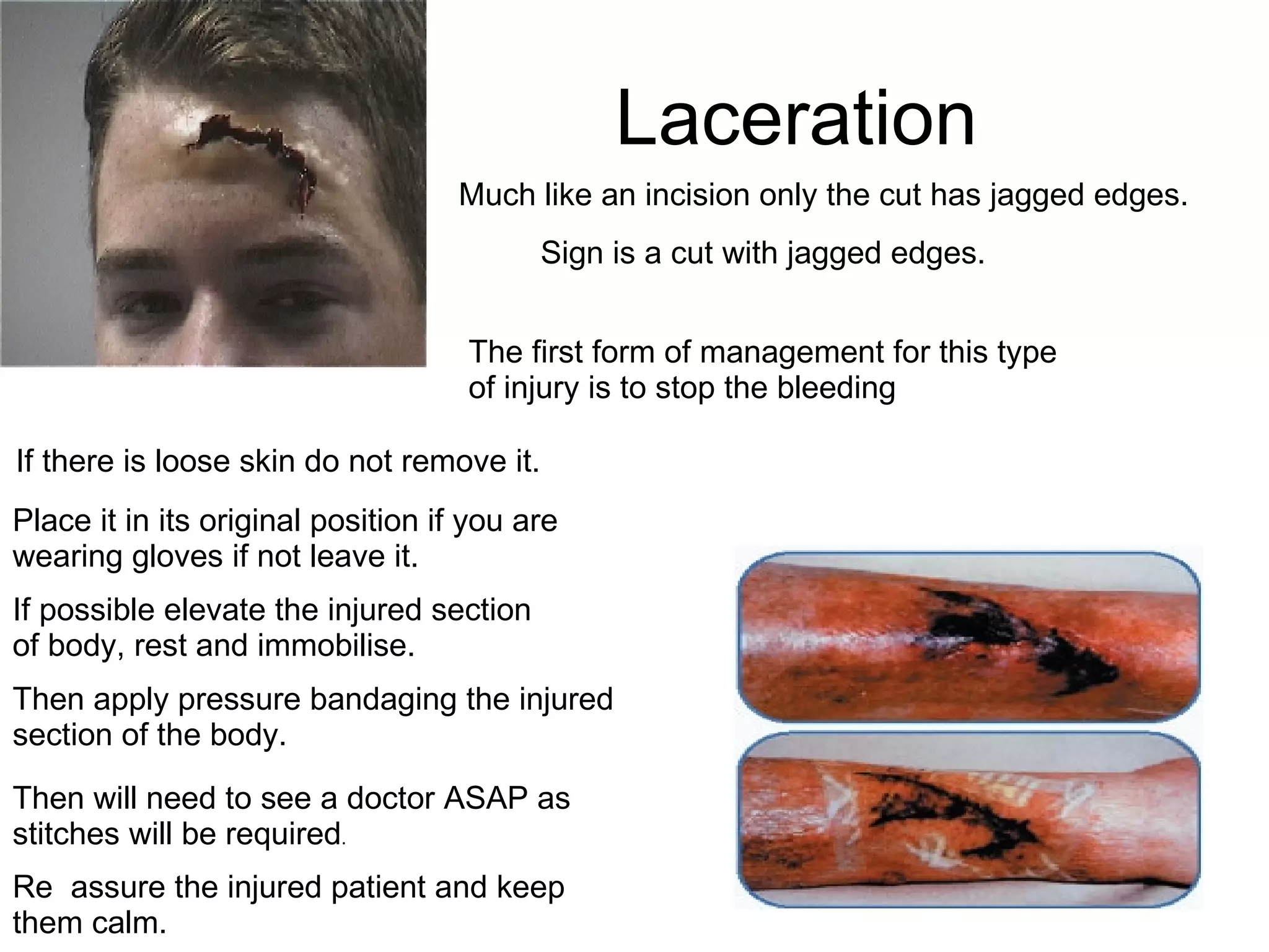 Laceration Sign is a cut with jagged edges.  The first form of management for this type of injury is to stop the bleeding If there is loose skin do not remove it.  Place it in its original position if you are wearing gloves if not leave it. Then apply pressure bandaging the injured section of the body.  Then will need to see a doctor ASAP as stitches will be required . Much like an incision only the cut has jagged edges. If possible elevate the injured section of body, rest and immobilise.  Re  assure the injured patient and keep them calm.  