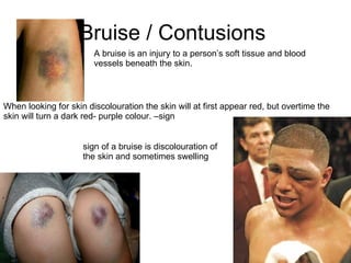 Bruise / Contusions  A bruise is an injury to a person’s soft tissue and blood vessels beneath the skin.  sign of a bruise is discolouration of the skin and sometimes swelling  When looking for skin discolouration the skin will at first appear red, but overtime the skin will turn a dark red- purple colour. –sign  