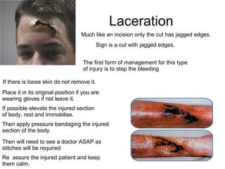 Laceration Sign is a cut with jagged edges.  The first form of management for this type of injury is to stop the bleeding If there is loose skin do not remove it.  Place it in its original position if you are wearing gloves if not leave it. Then apply pressure bandaging the injured section of the body.  Then will need to see a doctor ASAP as stitches will be required . Much like an incision only the cut has jagged edges. If possible elevate the injured section of body, rest and immobilise.  Re  assure the injured patient and keep them calm.  