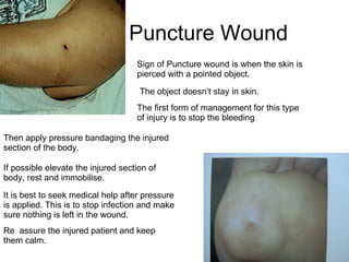 Puncture Wound  Sign of Puncture wound is when the skin is pierced with a pointed object. The object doesn’t stay in skin.  The first form of management for this type of injury is to stop the bleeding Then apply pressure bandaging the injured section of the body.  It is best to seek medical help after pressure is applied. This is to stop infection and make sure nothing is left in the wound.  If possible elevate the injured section of body, rest and immobilise.  Re  assure the injured patient and keep them calm.  