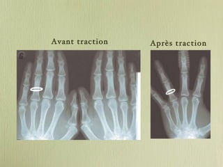 Avant traction Après traction 