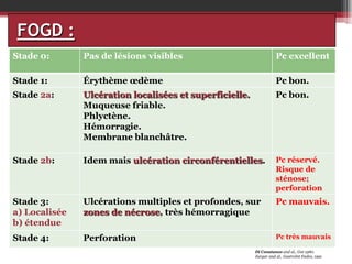 FOGD :
Stade 0:

Pas de lésions visibles

Pc excellent

Stade 1:

Érythème œdème

Pc bon.

Stade 2a:

Ulcération localisées et superficielle.
Muqueuse friable.
Phlyctène.
Hémorragie.
Membrane blanchâtre.

Pc bon.

Stade 2b:

Idem mais ulcération circonférentielles.

Pc réservé.
Risque de
sténose;
perforation

Stade 3:
a) Localisée
b) étendue

Ulcérations multiples et profondes, sur
zones de nécrose, très hémorragique

Pc mauvais.

Stade 4:

Perforation

Pc très mauvais
Di Constanzo and al., Gut 1980.
Zargar and al., GastroInt Endos, 1991

 