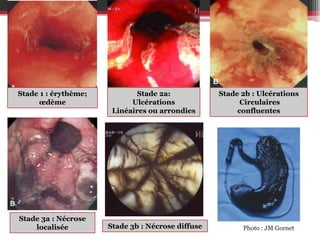 Stade 1 : érythème;
œdème

Stade 3a : Nécrose
localisée

Stade 2a:
Ulcérations
Linéaires ou arrondies

Stade 3b : Nécrose diffuse

Stade 2b : Ulcérations
Circulaires
confluentes

Photo : JM Gornet

 