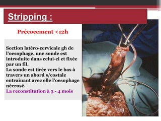 Stripping :
Précocement <12h
Section latéro-cervicale gh de
l'oesophage, une sonde est
introduite dans celui-ci et fixée
par un fil.
La sonde est tirée vers le bas à
travers un abord s/costale
entraînant avec elle l'oesophage
nécrosé.
La reconstitution à 3 - 4 mois

 