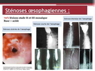 Sténoses œsophagiennes :
70% lésions stade II et III mosaïque
Base > acide
Sténose courte de l’œsophage
Sténose ulcérée de l’œsophage

Acta Endoscopica.Surveillance endoscopique des lésions muqueuses
digestives,après ingestion de caustiques,S. CLAUDEL, B. MOULINIER,
A. MARTIN, R. LAMBERT et R. DUCLUZEAU, Hôpital E.-Herriot,

Sténose étendue de l’œsophage

 