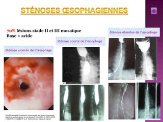 70% lésions stade II et III mosaïque                                                               Sténose étendue de l’œsophage
 Base > acide
                                                                     Sténose courte de l’œsophage

Sténose ulcérée de l’œsophage




Acta Endoscopica.Surveillance endoscopique des lésions muqueuses
digestives,après ingestion de caustiques,S. CLAUDEL, B. MOULINIER,
A. MARTIN, R. LAMBERT et R. DUCLUZEAU, Hôpital E.-Herriot,
 