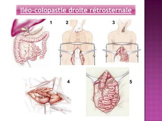 Iléo-colopastie droite rétrosternale
         1    2              3




               4                   5
 