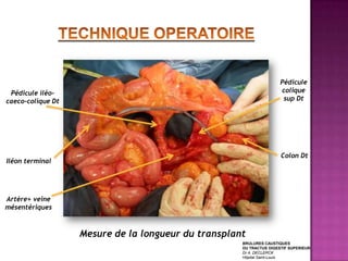 Pédicule
 Pédicule iléo-                                                      colique
caeco-colique Dt                                                      sup Dt




                                                                     Colon Dt
Iléon terminal




Artère+ veine
mésentériques



                   Mesure de la longueur du transplant
                                                     BRULURES CAUSTIQUES
                                                     DU TRACTUS DIGESTIF SUPERIEUR
                                                     Dr A. DECLERCK
                                                     Hôpital Saint-Louis
 
