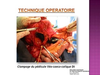 Clampage du pédicule iléo-caeco-colique Dt
                                      BRULURES CAUSTIQUES
                                      DU TRACTUS DIGESTIF SUPERIEUR
                                      Dr A. DECLERCK
                                      Hôpital Saint-Louis
 