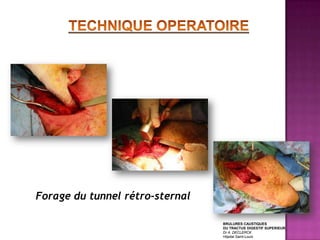 Forage du tunnel rétro-sternal

                                 BRULURES CAUSTIQUES
                                 DU TRACTUS DIGESTIF SUPERIEUR
                                 Dr A. DECLERCK
                                 Hôpital Saint-Louis
 