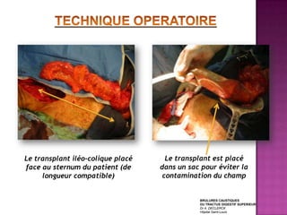 Le transplant iléo-colique placé     Le transplant est placé
face au sternum du patient (de     dans un sac pour éviter la
     longueur compatible)           contamination du champ


                                              BRULURES CAUSTIQUES
                                              DU TRACTUS DIGESTIF SUPERIEUR
                                              Dr A. DECLERCK
                                              Hôpital Saint-Louis
 