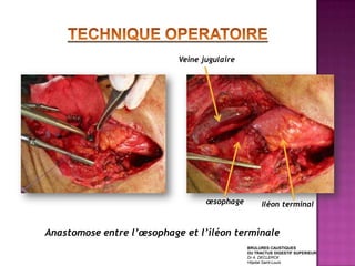Veine jugulaire




                                  œsophage        Iléon terminal


Anastomose entre l’œsophage et l’iléon terminale
                                             BRULURES CAUSTIQUES
                                             DU TRACTUS DIGESTIF SUPERIEUR
                                             Dr A. DECLERCK
                                             Hôpital Saint-Louis
 