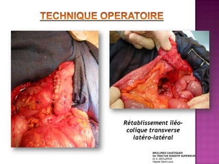 Rétablissement iléo-
 colique transverse
   latéro-latéral

         BRULURES CAUSTIQUES
         DU TRACTUS DIGESTIF SUPERIEUR
         Dr A. DECLERCK
         Hôpital Saint-Louis
 