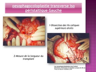 oesophagocoloplastie transverse iso
      péristaltique Gauche


                             1-Dissection des Vx coliques
                                   supérieurs droits




                       1



2-Mesure de la longueur du
       transplant                                                                          2

                                 Les oesophagocoloplasties chez l’enfant:
                                 Indications, techniques et résultats à propos de 36 cas
                                 Thèse de Mariem khalfallah 2008
 